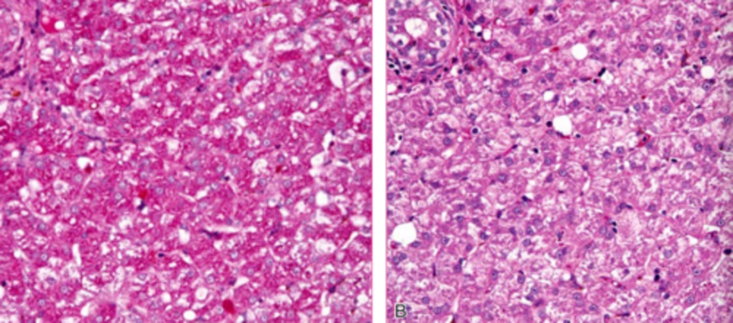 <p>Both of these images are PAS stains to see glycogen... what's different about them?</p>