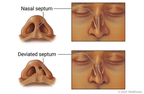 <p>nasal septum</p>