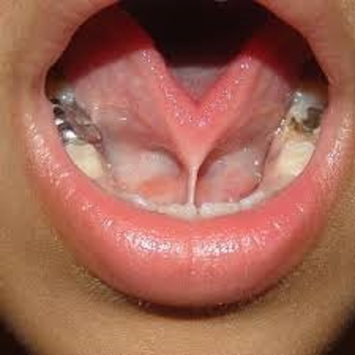 <p>• Short, thick lingual frenum</p><p>resulting in limitation of tongue</p><p>movement</p>