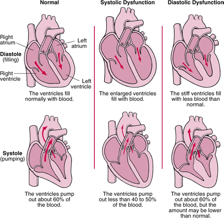 <ul><li><p>Systolic (HRrEF) → Eccentric </p></li><li><p>HFmrEF</p></li><li><p>Diastolic (HFpEF) → Concentric </p></li></ul><p></p>
