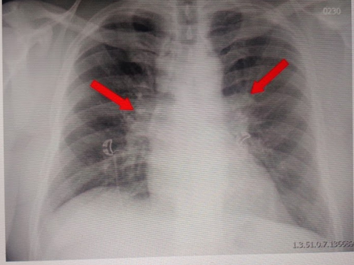 <p>tuberculosis</p>