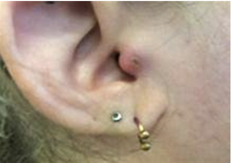 <p><span>How would you document the assessment findings of the tragus?</span></p><p></p>