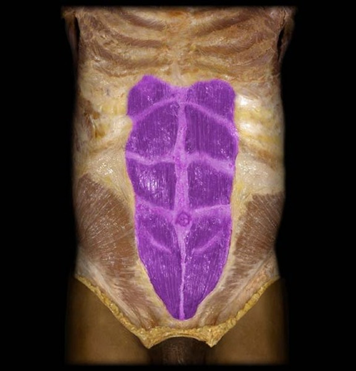 <p>Vertical abdominal muscle, flexes spine.</p>