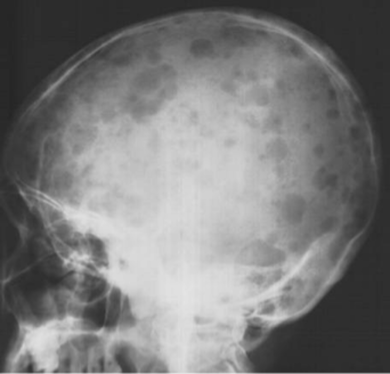 <p>_____ of skull lesions are blastic</p>