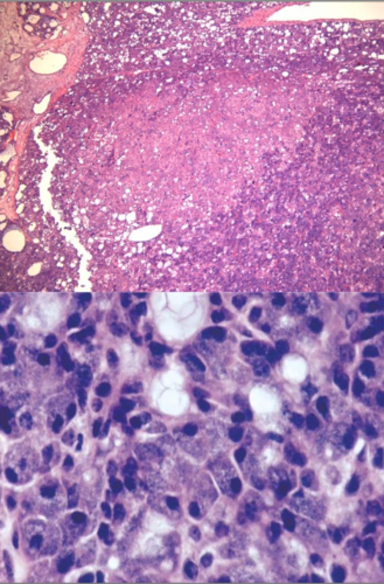 <p>• Well circumscribed</p><p>• May show infiltration</p><p>• Serous acinar cell</p><p>▫ Cells containing abundant granular cytoplasm</p><p>▫ Zymogen granules</p>