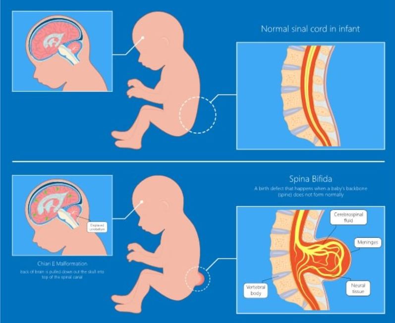 <p>Descibe Spina Bifida</p>