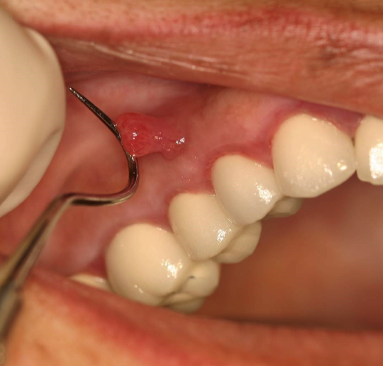 <p>on gingiva facial to non-vital tooth </p>