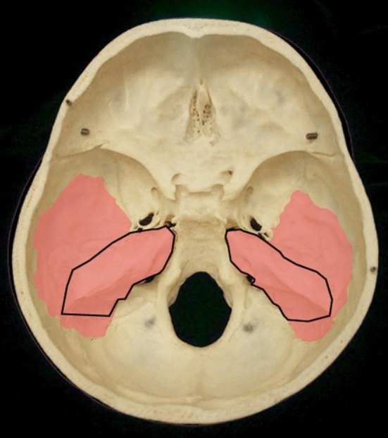 <p>the &quot;mountain range&quot; elevation on the internal surface of the temporal bone. The structures of the middle and inner ear are contained within this.</p>