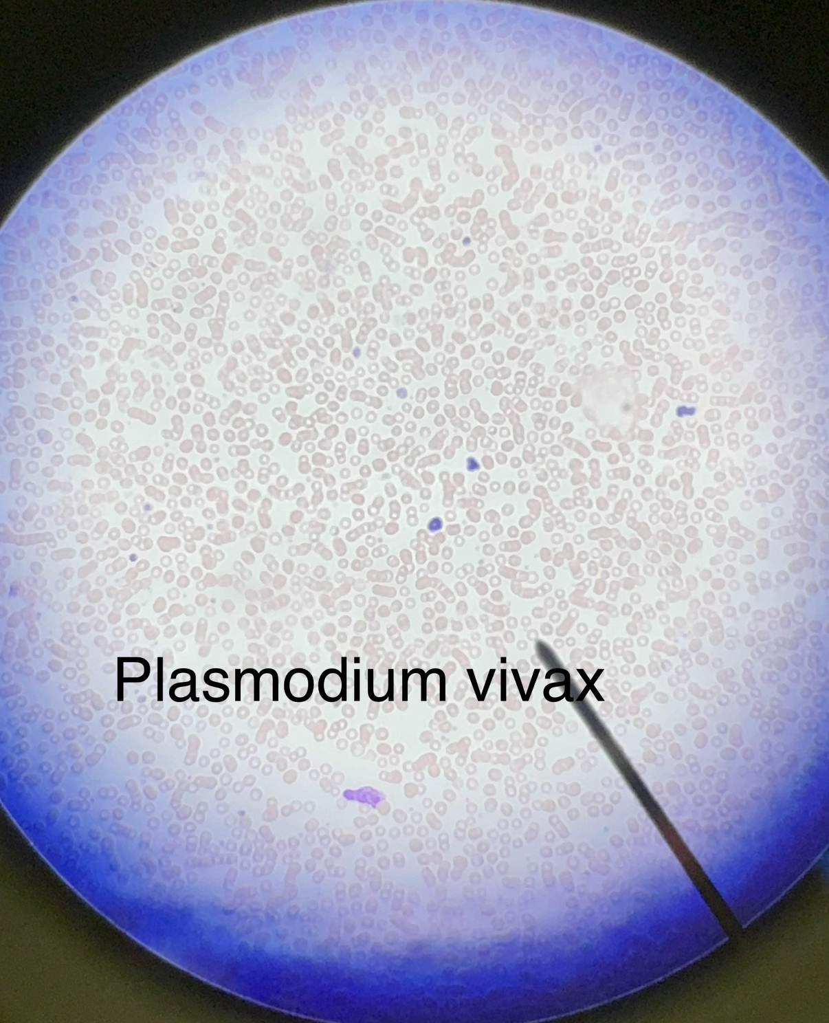 <p>Domain: Eukarya</p><p style="text-align: start">Kingdom: Protista</p><p style="text-align: start">Phylum: Apicomplexa</p><p style="text-align: start">Genus: Plasmodium</p><p style="text-align: start">Species: vivax</p><p style="text-align: start">“Ring form” inside of red blood cells causes malaria</p><p style="text-align: start">Blood-Bourne pathogen</p><p style="text-align: start">There are 4 separate species that can cause malaria and are spread by 60 different species of Anopheles mosquito (biological vector)</p><p style="text-align: start">Malaria is an endemic to more than 90 nations</p><p style="text-align: start">Anti-malarial drugs are used to treat/ given to travelers</p><p style="text-align: start">1st malaria vaccine introduced in Africa in 2022</p><p style="text-align: start">Very effective when used in combo with prophylactic anti-malarial drugs</p><p style="text-align: start">*Study cycle*</p>