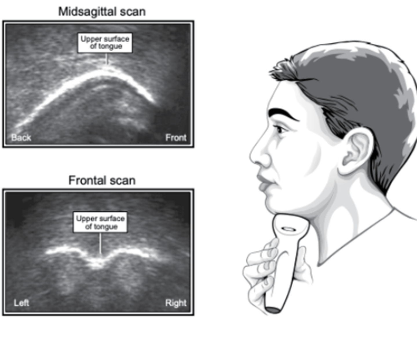 <p>The transducer generates a signal that reflects back when it encounters airand is picked up by a senso</p><p>Can be used to image tongue and pharyngeal movements during swallowing</p>