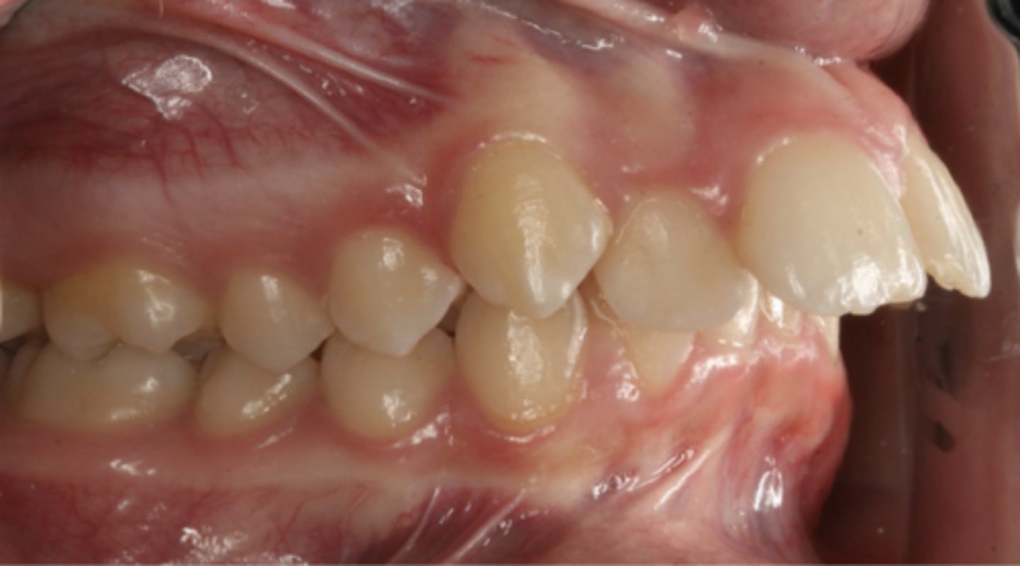 <p>Class II division 1</p>