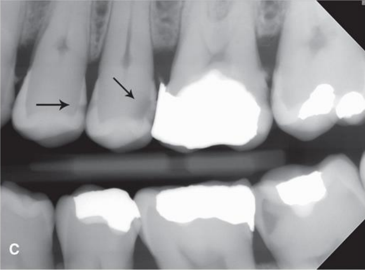 <p>classify this lesion according to the ADA and ICDAS/ICCMS systems </p>