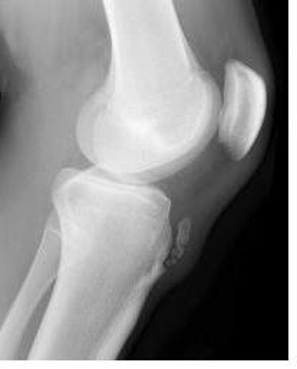 <p>high riding patella</p>