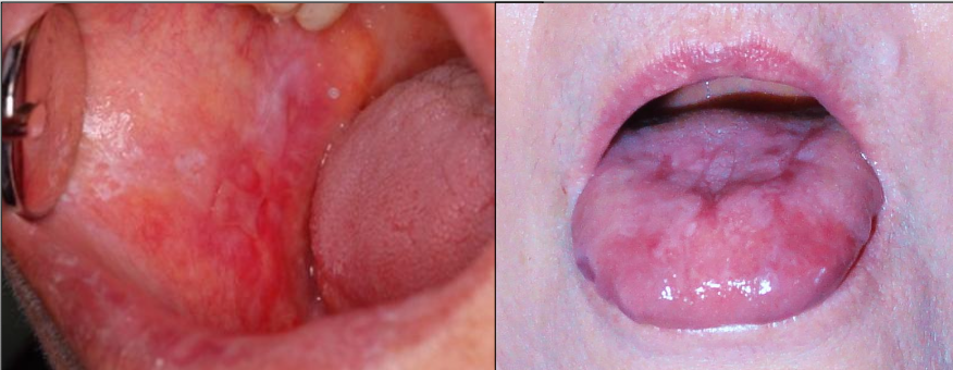 <p>Not as common, painful, erythematous, bleeding</p>