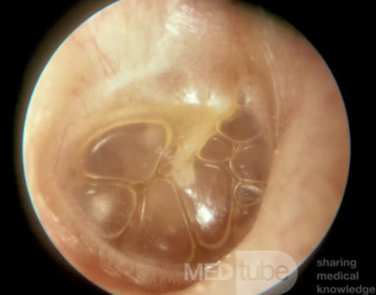 <p>Fluid buildup in the middle ear that can follow acute otitis media or caused by obstruction of the Eustachian tube</p>
