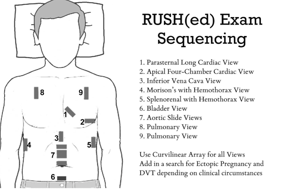<p>ultrasound to quickly assess any patient with undifferentiated <strong>shock and hypertension </strong></p>