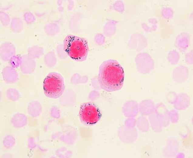 <p>what are sideroblasts? (RBC inclusions)</p>