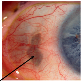 <ul><li><p>Innocuous condition seen in <strong>elderly px</strong>, close to the insertion of the medial or lateral muscles</p></li><li><p>RF; <span style="color: red"><strong>age, females, moderate to high myopia and degenerative arthritis</strong></span></p></li></ul><p></p>