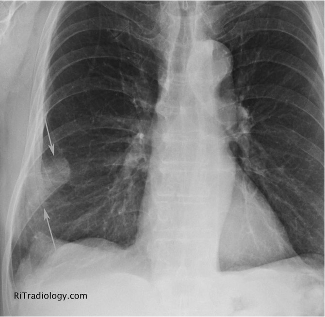 <p>rare; wedge shaped, pleura based triangular opacity w/ an apex pointing toward the hilus</p><p>pathognomic for PE</p>