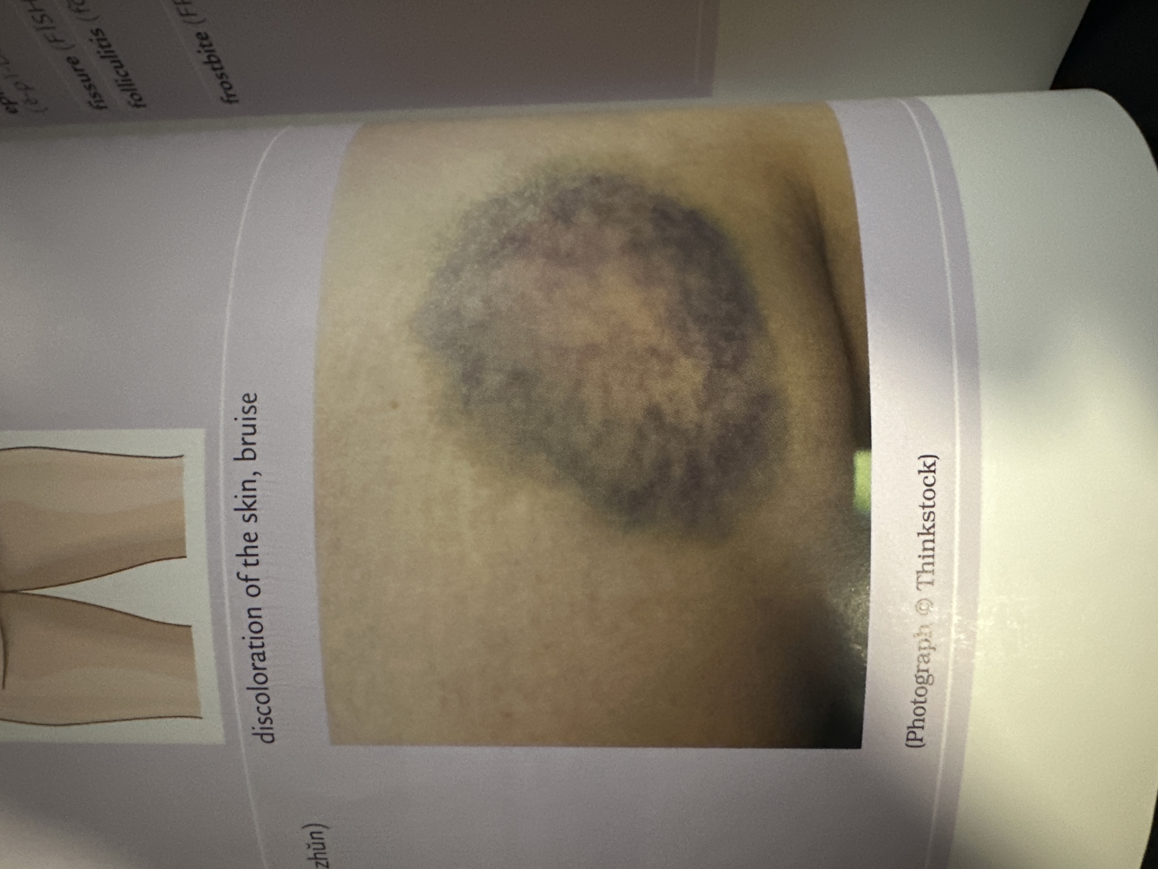 discoloration of the skin; bruise

