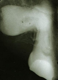 <p>dx (by cementum only) </p>
