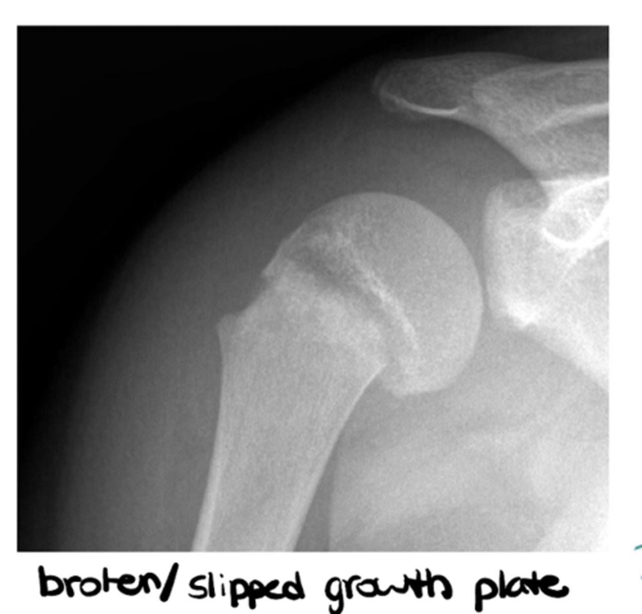 <p>Cartilage in the middle of bone that gives the bone room to grow and solidifies over time -- think pediatric patients</p>