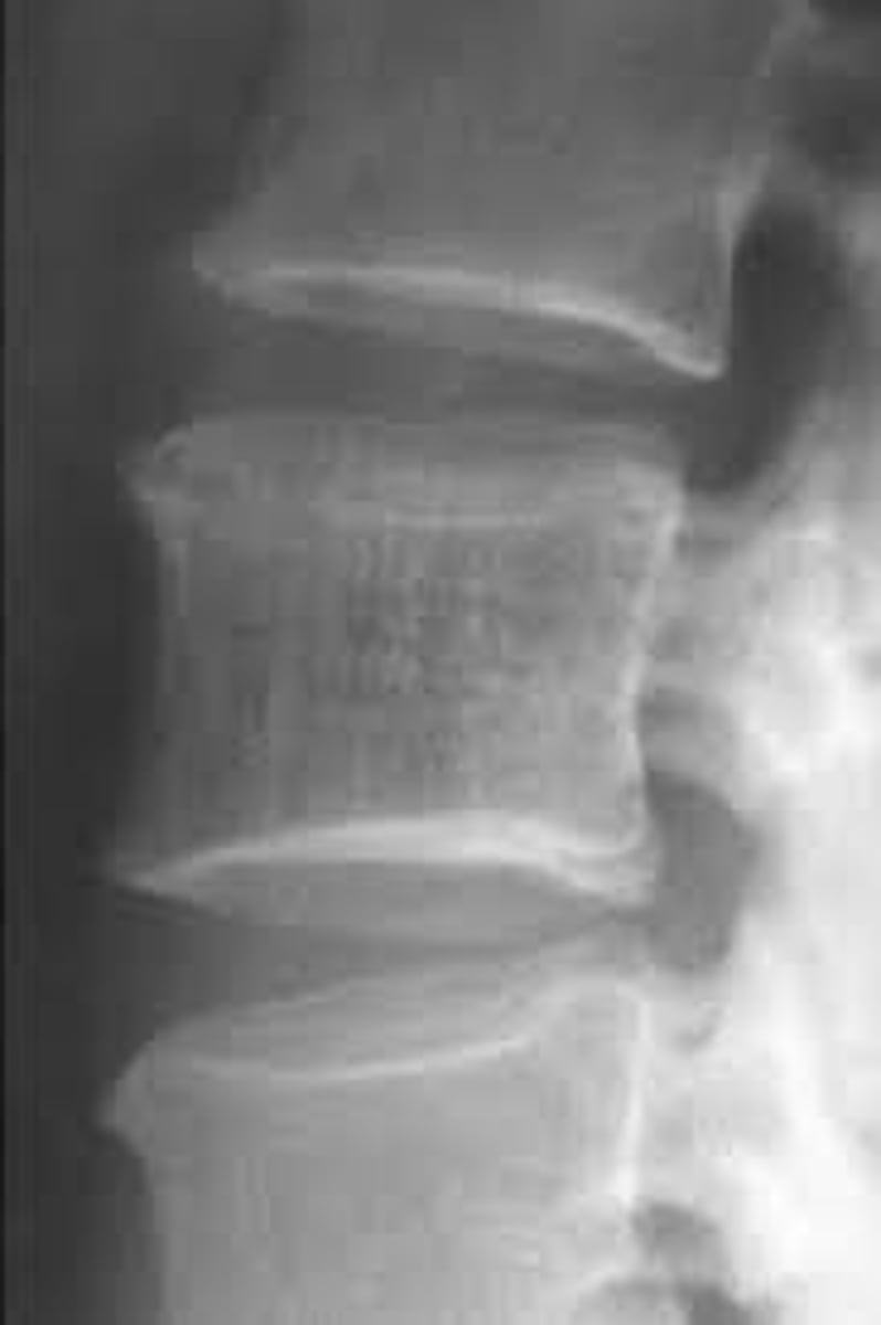 <p>Vignette # 15</p><p>Sex: Female</p><p>Age: 45</p><p>Chief Complaint: Patient presents with a gradual onset of low back pain. She reports doing light secretarial work that sometimes makes it worse.</p><p>Objective Findings: Rolled shoulders, anterior head carriage, tight lumbar paraspinal muscles</p><p>Diagnostic imaging: X-ray</p><p>2. What else could be seen in this condition? (Choose 3)</p><p>a. Vertebral body collapse</p><p>b. Pseudo fracture</p><p>c. Vertebral body expansion</p><p>d. Metastasis</p><p>e. Brown’s tumor</p><p>f. Spinal stenosis</p><p>g. Gardener’s syndrome</p><p>h. Skull enlargement</p>