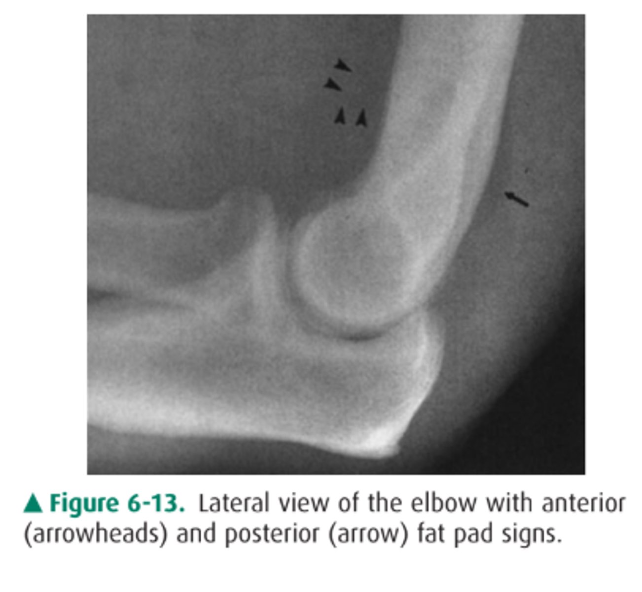 <p>B.</p><p>You have the anterior sail sign and posterior fat pad sign.</p>