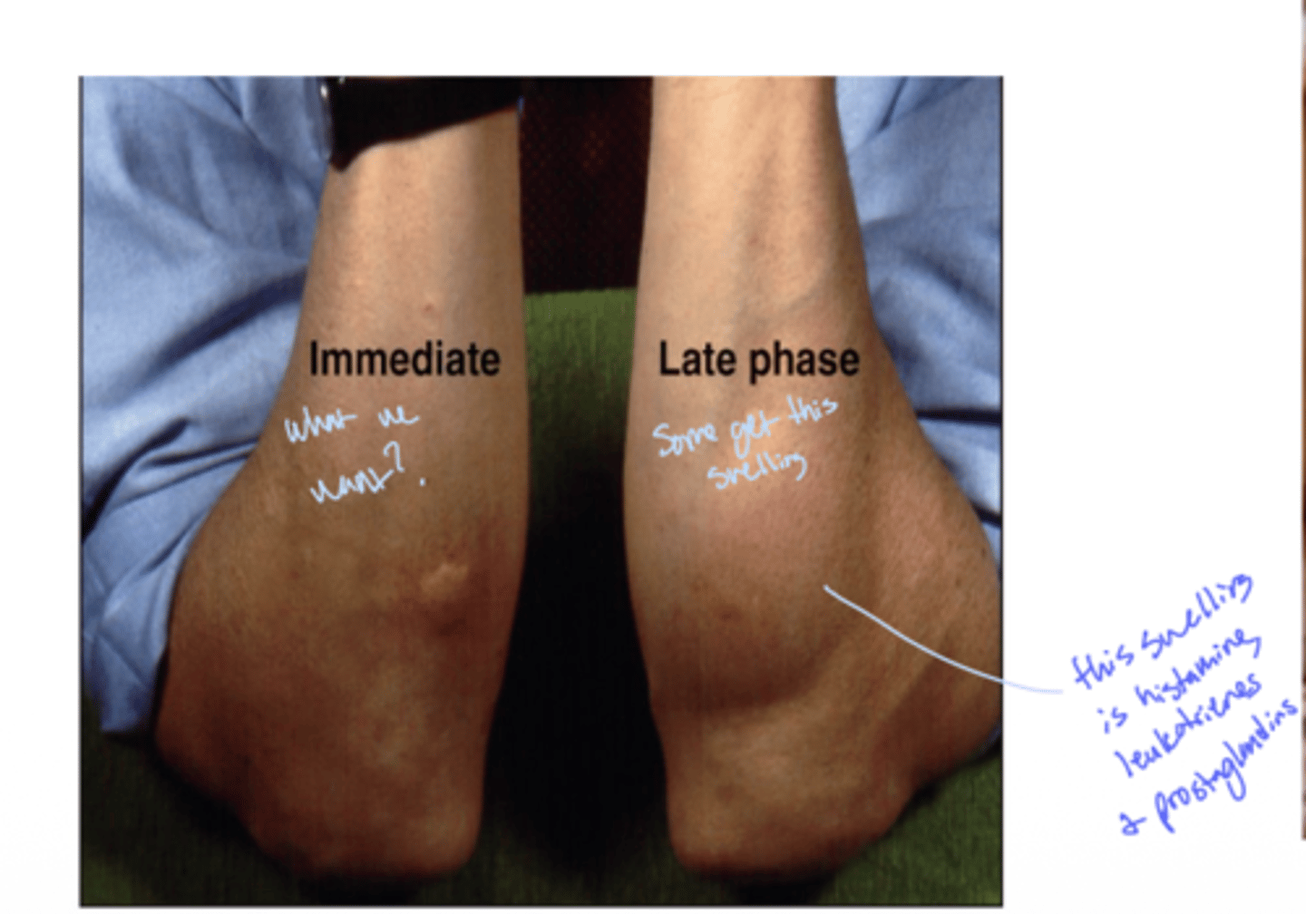 <p>A: Late-phase reaction</p><p>see how the late phase is histamine, leukotrienes and prostaglandins</p>