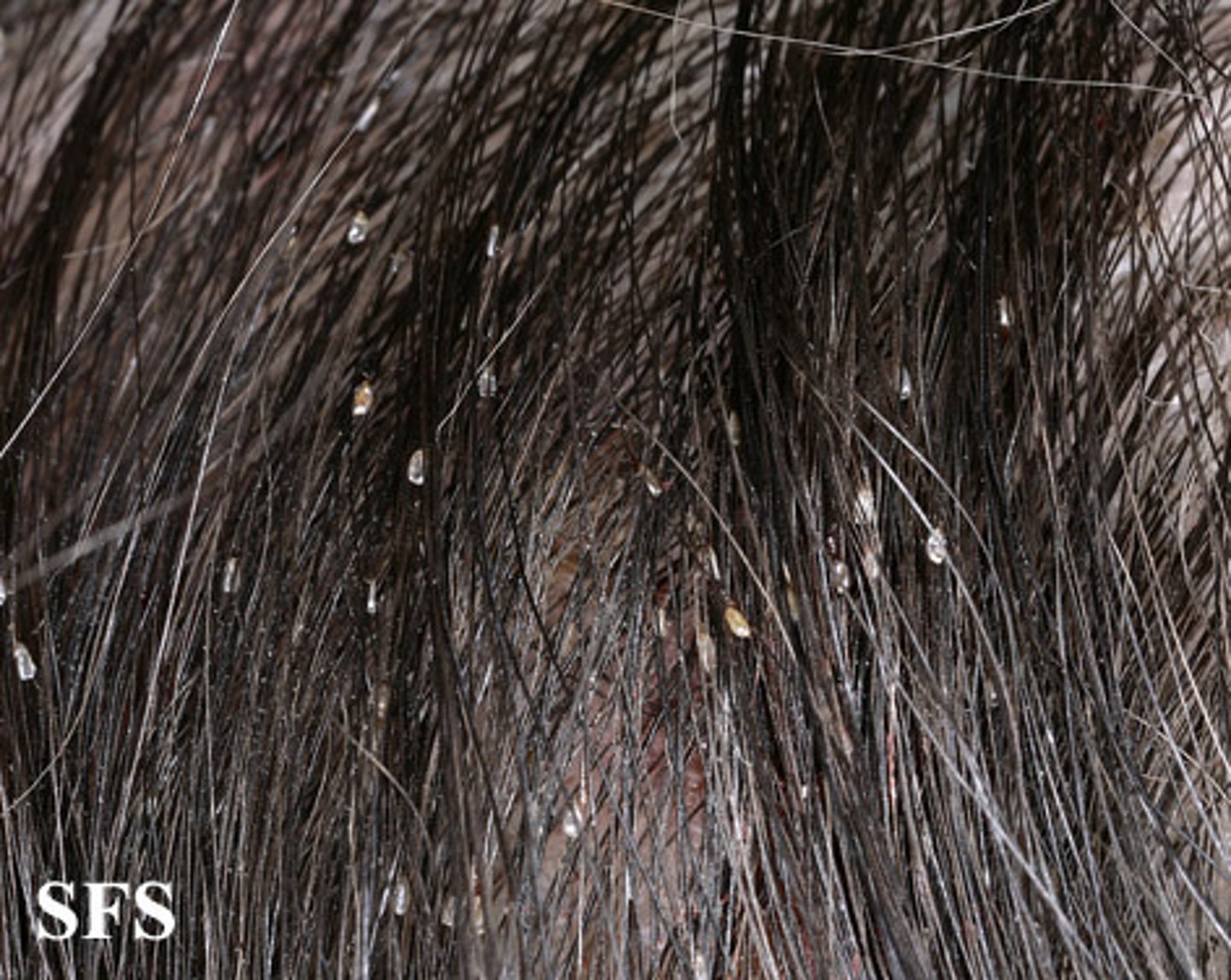 <p>an infection with lice</p>