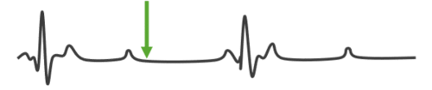 <p>condition where AV node is defective and few or no impulses reach ventricles</p>