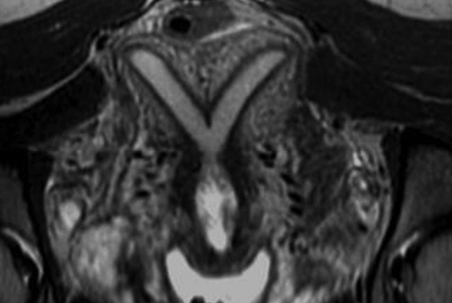<p>what uterine anomaly is this?</p>