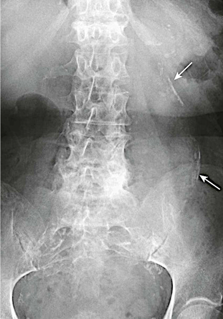 <p>-common in those with DM and atherosclerosis </p><p>-aorta has rim like calcifications</p><p>-aneurysm is when normal diameter exceeds 50% of normal size</p>