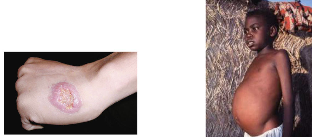 <ul><li><p>cardiovascular/lymphatic protozoal disease</p></li><li><p>cause: <em>Leishmania donovani</em></p><ul><li><p>taken by macrophage → multiplies and circulates → systemic infection</p></li><li><p>virulence: opportunistic</p></li></ul></li><li><p>transmission: sandfly bite</p></li><li><p>symptoms: fever, anemia, swelling due to enlargement of spleen and liver</p><ul><li><p>other <em>Leishmania</em> species can cause cutaneous leishmaniasis</p></li></ul></li></ul><p></p>