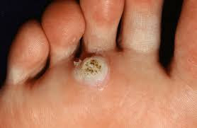 <p>AKA plantar warts can cause mild pain if located on WB areas; often caused by sanitary behaviors like walking barefoot </p>