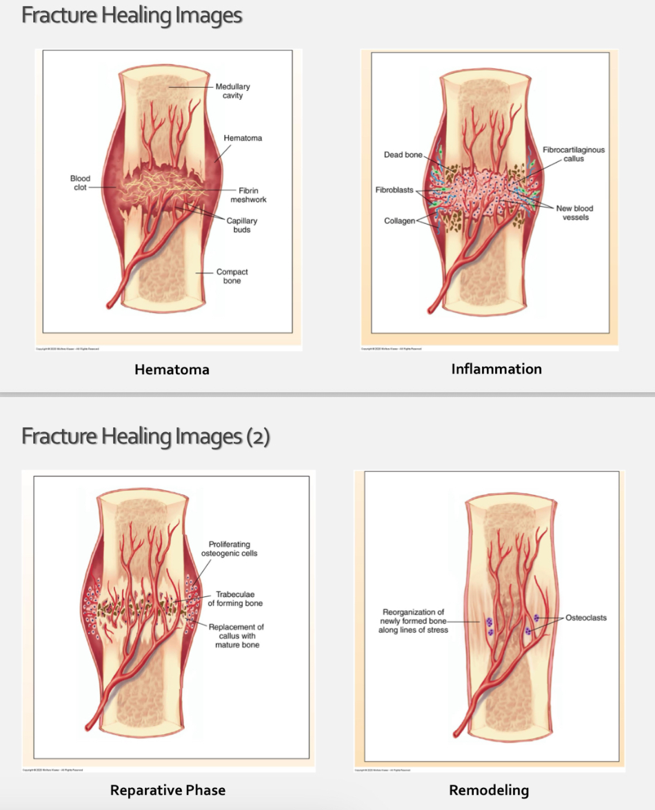 <p>Hematoma formation</p><ul><li><p>Days 1-5 </p></li></ul><p>Inflammatory phase</p><ul><li><p>days 5-11</p></li></ul><p>Reparative </p><ul><li><p>days 11-28 </p></li></ul><p>Remodeling</p><ul><li><p>start at day 18 and may continue for many months or years </p></li></ul><p></p>