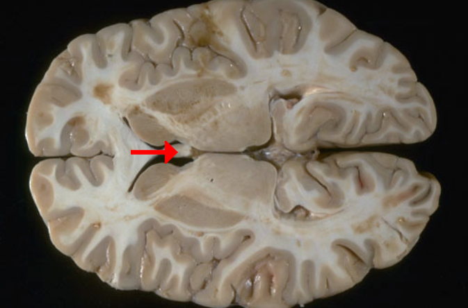 <p>Name this brain structure</p>