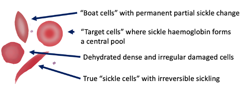 <ul><li><p>Permanent, irreversible sickling </p><ul><li><p>Pointy ends</p></li></ul></li></ul><p></p>