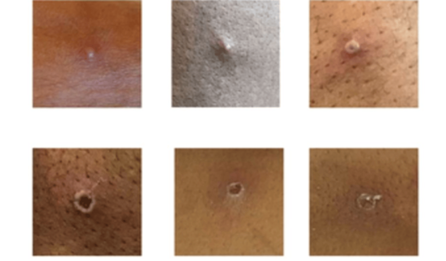 <p>-Disease caused by infection with mpox virus</p><p>-Blister then scab</p>
