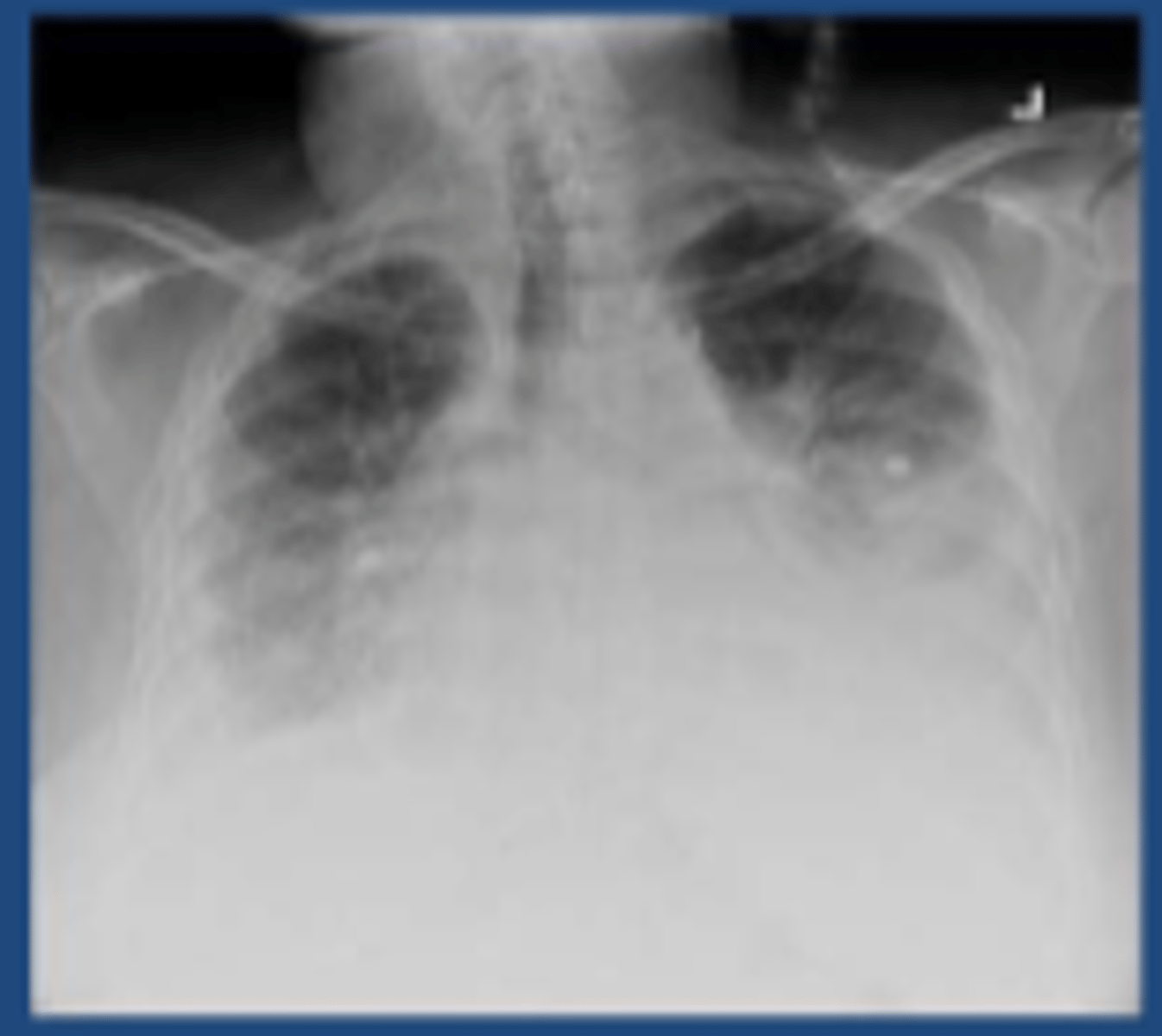 <p>Atelectasis/ Hypoventilation</p>