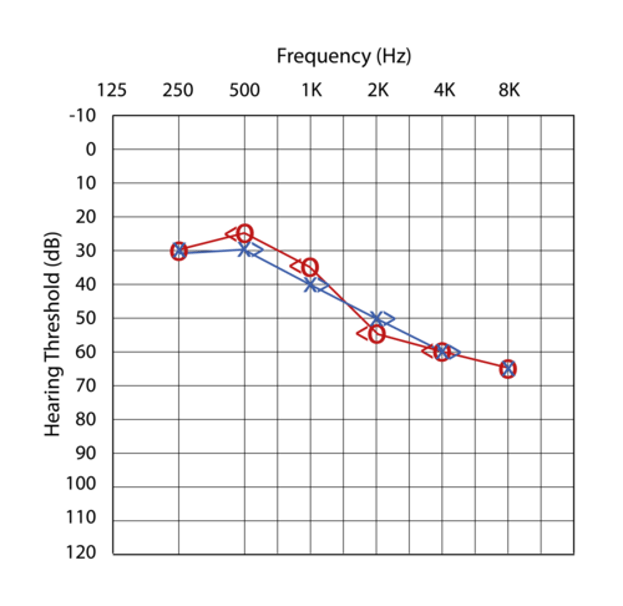 <p>Both air and bone conduction are impaired so hearing threshold increases for both</p>