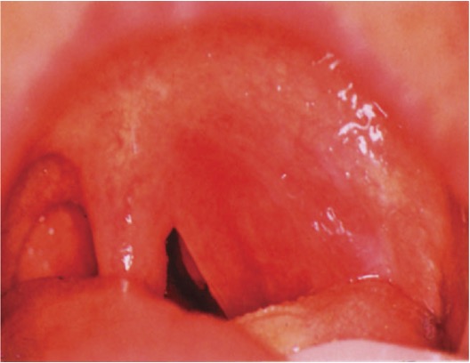 <p>severe odynophagia, trismus, uvula deviation, hot potato</p>