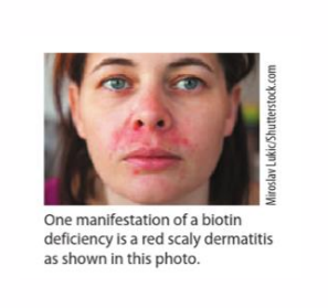 <p>Biotin (Vitamin B7) Deficiency</p>