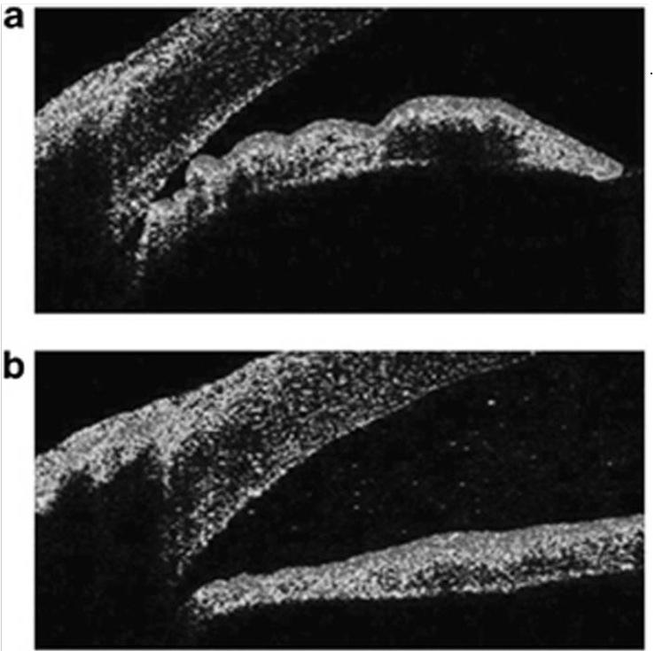 <p>The top image is Pre-LPI. The bottom image is post-LPI. With the difference noted between the 2 images, what type of angle configuration do we expect to be the issue in this angle closure patient?</p>