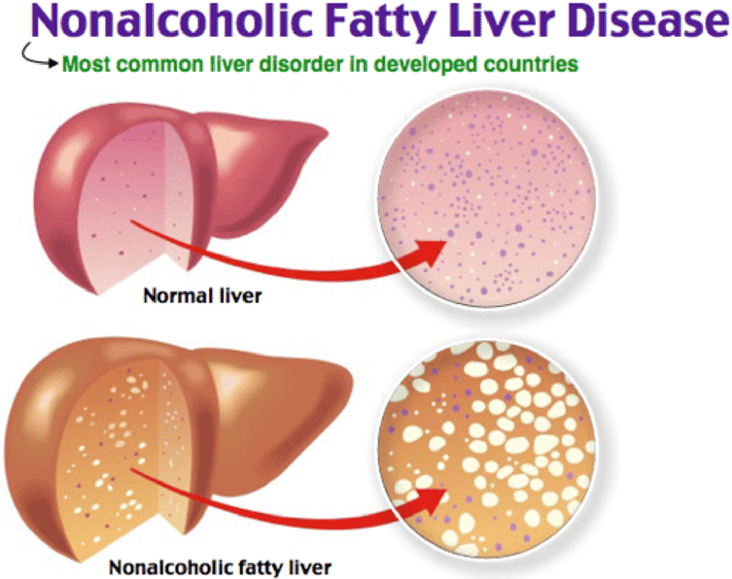 <p>Choline is required for lipid transport</p><p>1) Nonalcoholic fatty liver disease (fat stuck in the liver)</p><p>2) Muscle damage (fat stuck in the muscle)</p><p>3) Liver damage</p>