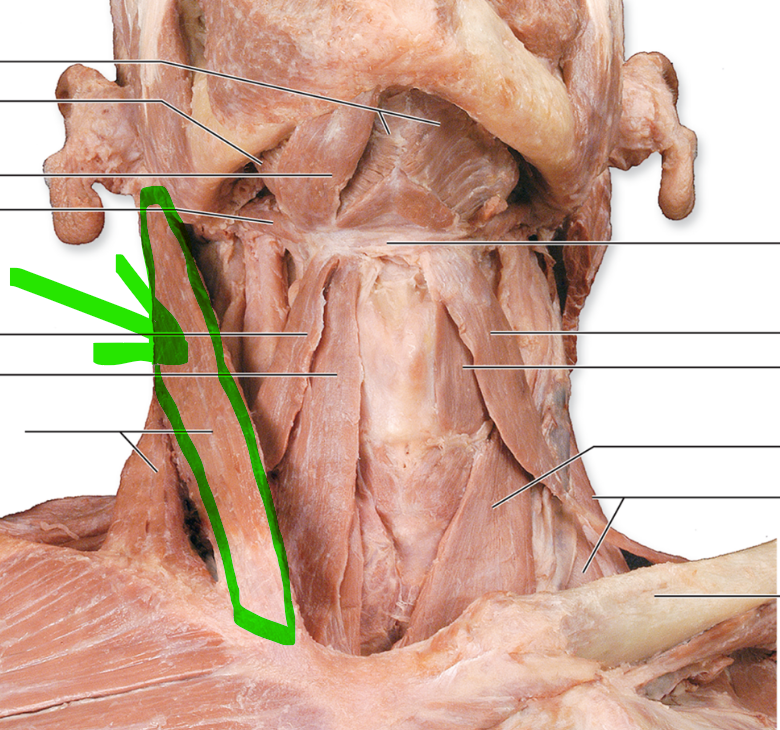 <p>sternocliedomastoid</p>