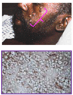 <p>32 years old male, HIV+.</p><p>Presents with papules, often umbilicated, on his face and body.</p><p>Sample obtained by curettage from one of the papules showed an encapsulated yeast.</p><p>Cultures of CSF, blood and skin grew Cryptococcus neoformans.</p><p>He was successfully treated with Amphotericin B, followed by daily oral fluconazole</p>