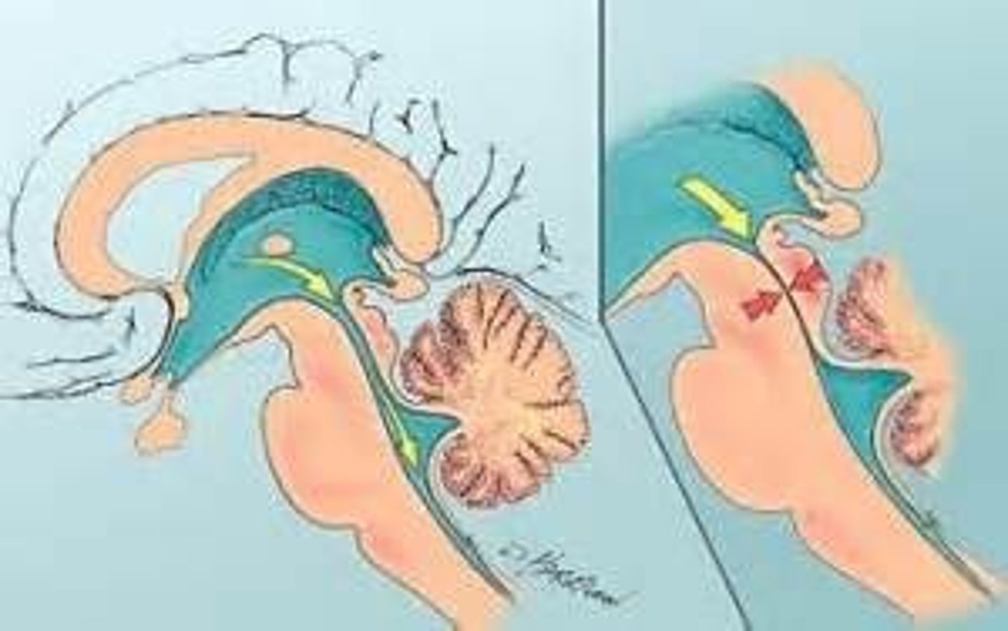 <p>Obstruction to the flow of CSF through the ventricular system</p>