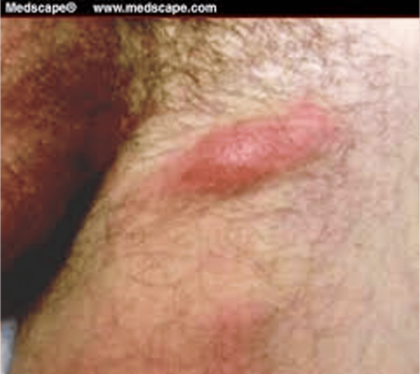 <p>swelling associated with shaving</p>