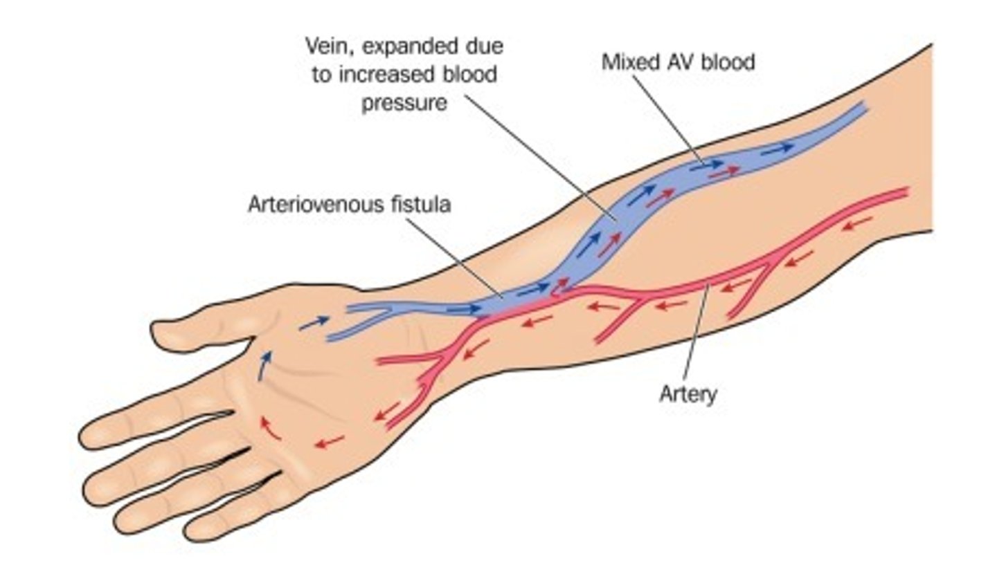<p><strong><u>surgical connection or “anastomosis” between an artery and a vein</u></strong><br>→connection causes turbulence and vein wall to thicken<br>→providing a spot that can be punctured repeatedly with dialysis needles + rapid blood flow rate</p><p><em>Limitations:</em><br>-minimum 6 weeks maturation period before use<br>-Requires good vessels</p><p><em>Advantages:</em><br>-native vessel, no reaction to synthetic material<br>-Long life<br>-Low risk of thrombosis<br>-low infection risk</p>
